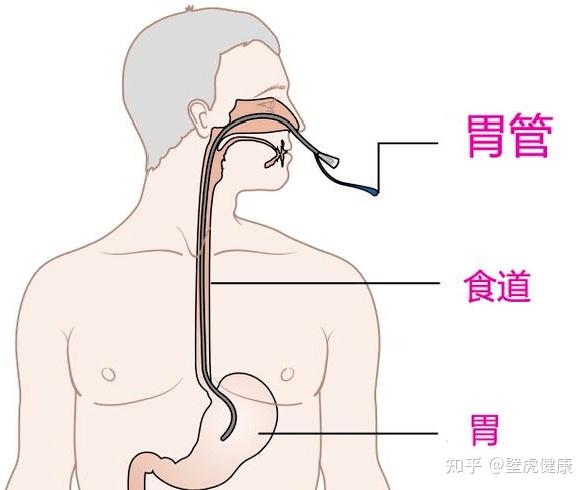格尔护士：护理服务不止于医院，出院后护士上门为患者更换胃管 - 知乎