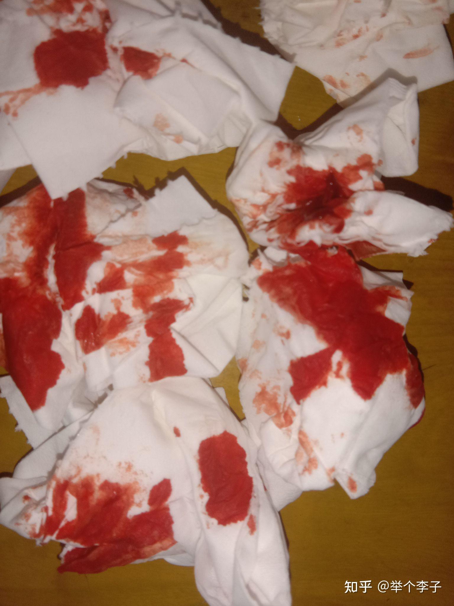 长痈是个什么感觉 - 知乎