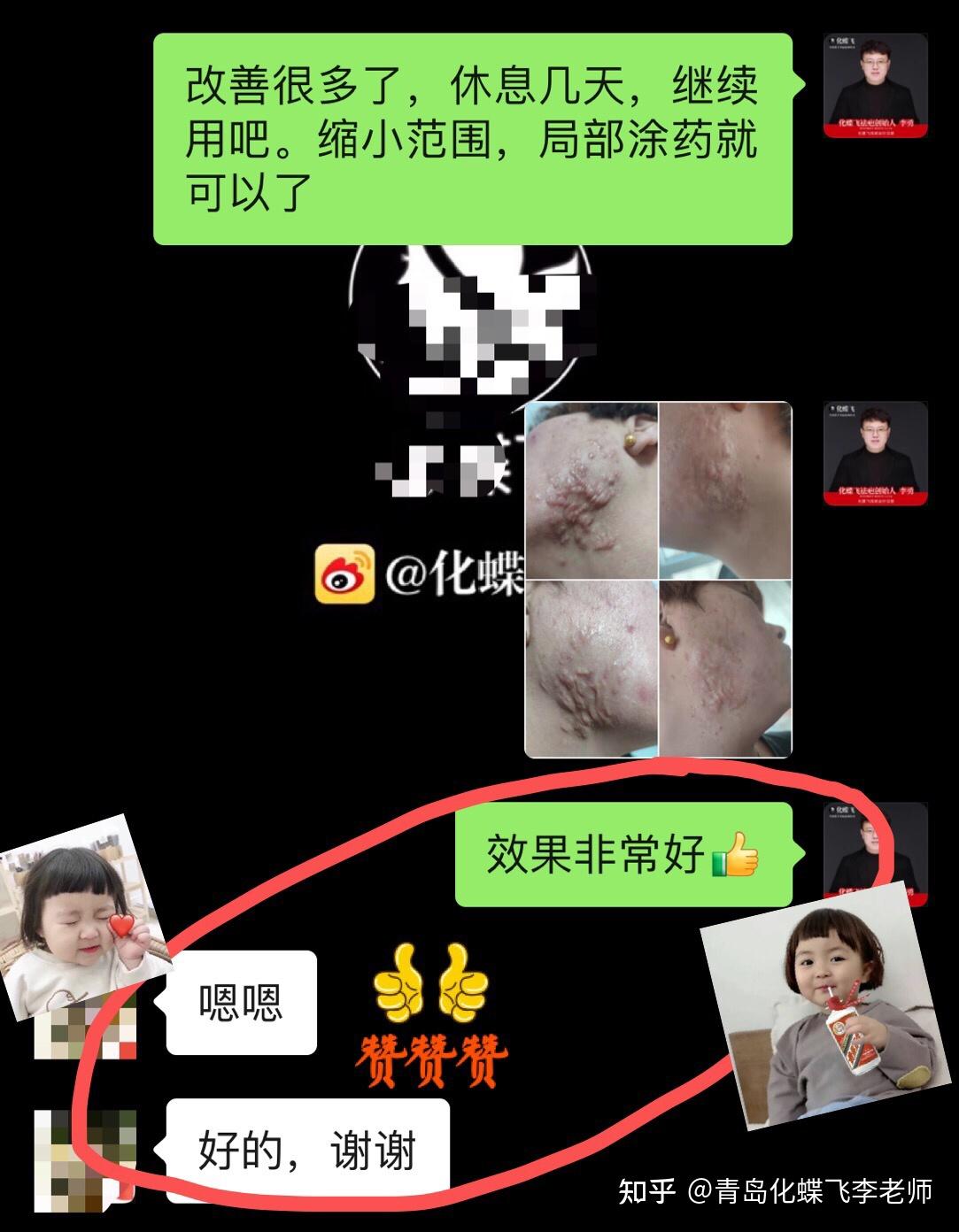 非常严重的痤疮结节疤痕