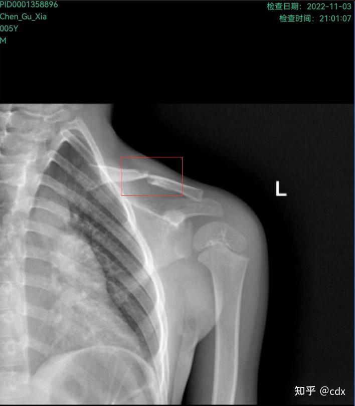 晚上急诊挂号就能看上医生,急诊医生开了dr拍片,确认是左锁骨位骨折