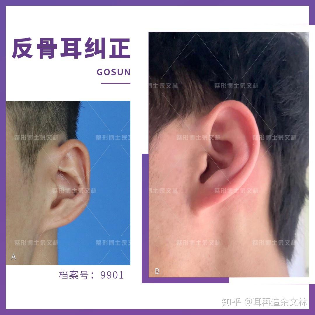 对耳轮恢复正常形态,耳甲腔,耳轮内外呈好看的c形,整个耳廓外形美观
