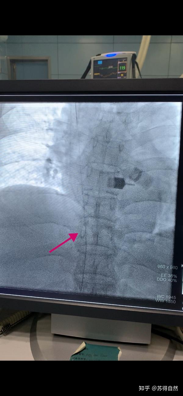 直穿无名及上腔留置长期导管1例