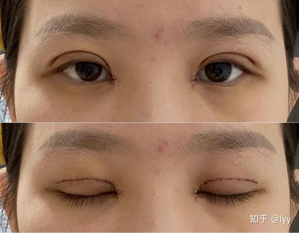 记录双眼皮恢复过程全切开眼角上睑下垂矫正202046