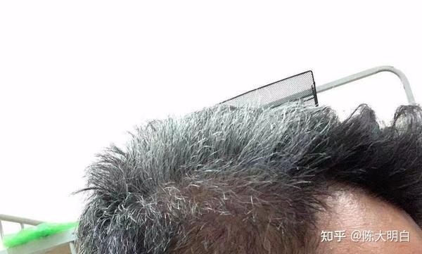 一名少白头患者的改善经历(有更新) - 知乎