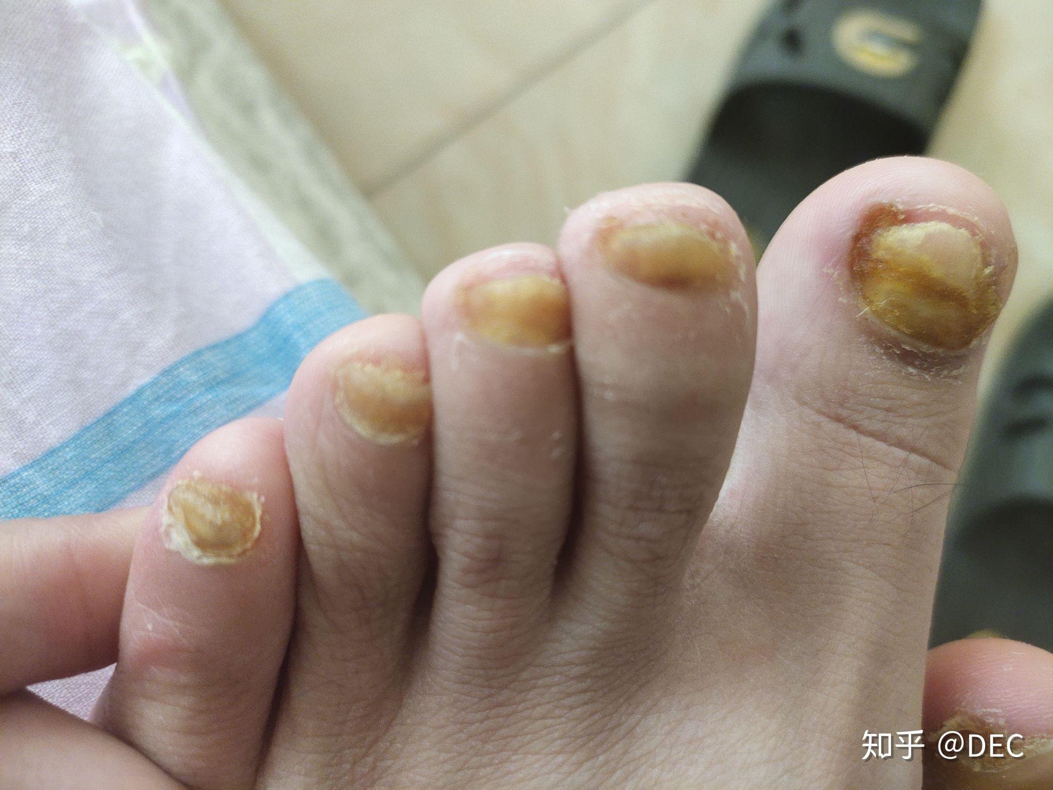 因为我右脚有4个脚趾是轻微症状,脱甲精油对此也不太有效,所以这4个