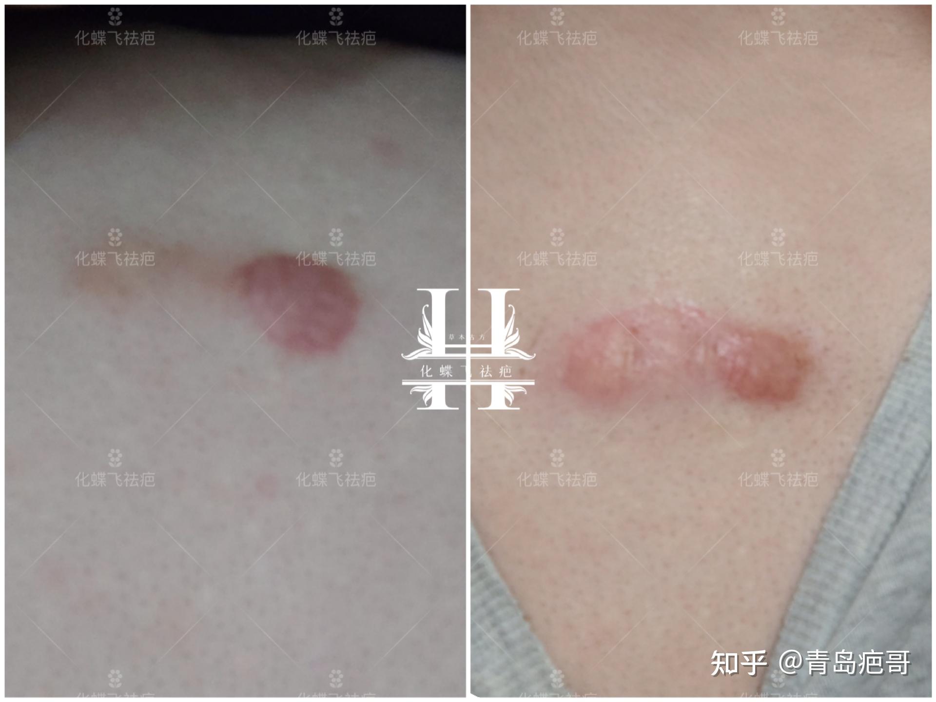 治疗疤痕疙瘩被坑无数次!别再踩雷了!