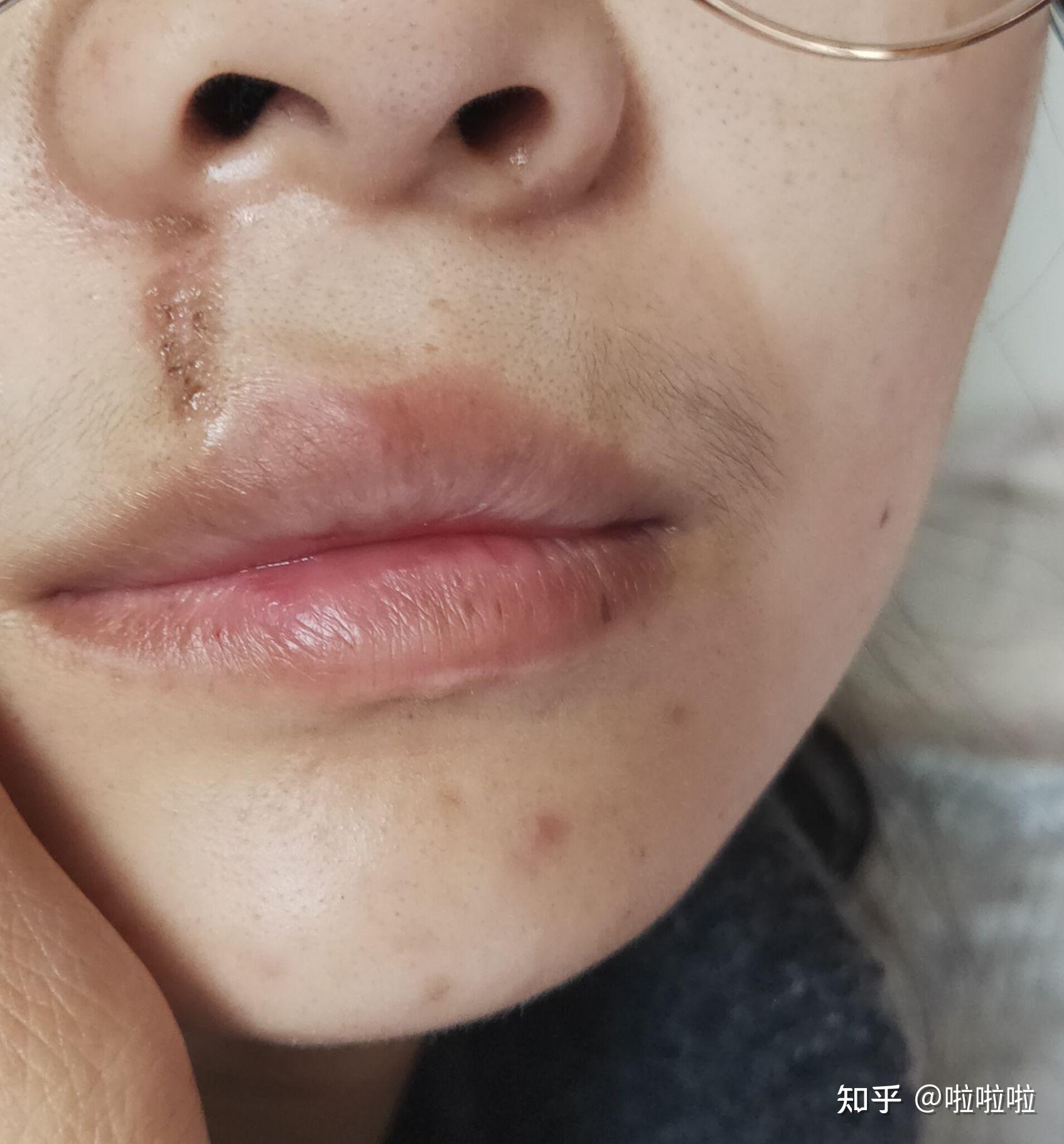 手术切痣经验篇,上嘴唇,较大 - 知乎