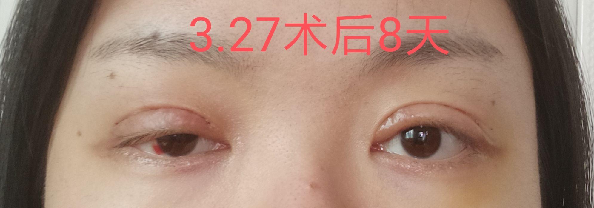 记录上睑下垂 双眼皮手术后恢复过程