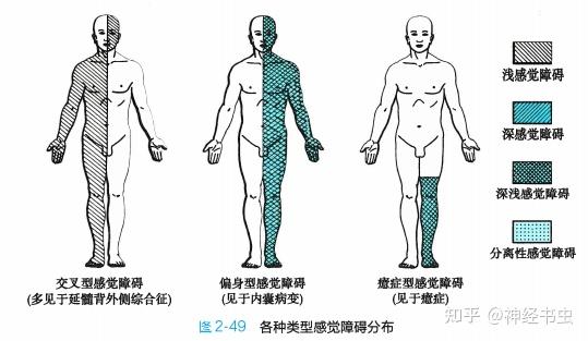 为病变对侧平面以下痛,温觉缺失而触觉和深感觉保存(分离性感觉障碍)