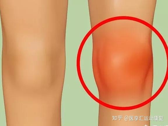 了解半月板重度撕裂的症状.