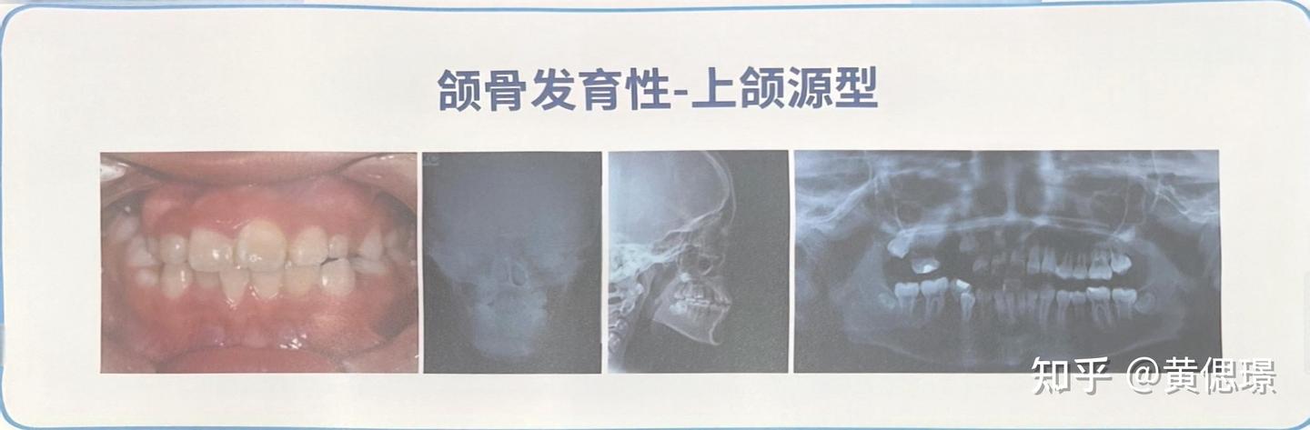 正畸诊断沈刚分类之偏颌 - 知乎