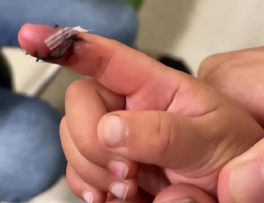 郑爽虐童风波升级孩子深度割伤烫伤郑爽称是玻璃女儿称是剪刀