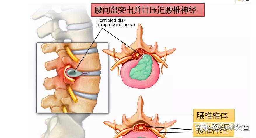 腰椎間盤突出壓迫神經怎麼治療