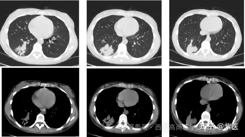 妙龄少女不明原因发热、胸痛、痰中带血,CT诊断肺部特殊感染 - 知乎