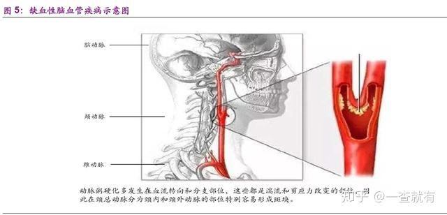 介入治疗300亿市场规模带来的投资机遇