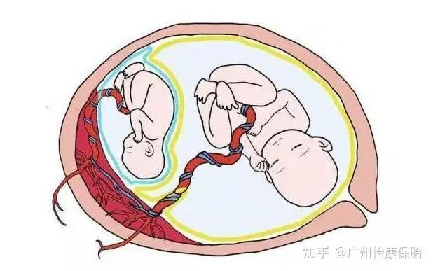双胎妊娠,也分两种! - 知乎