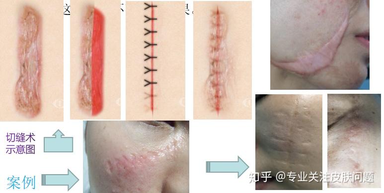 切縫朮後最終都會留下手術刀疤:傳統的技術有切縫術,植皮術,皮膚擴張