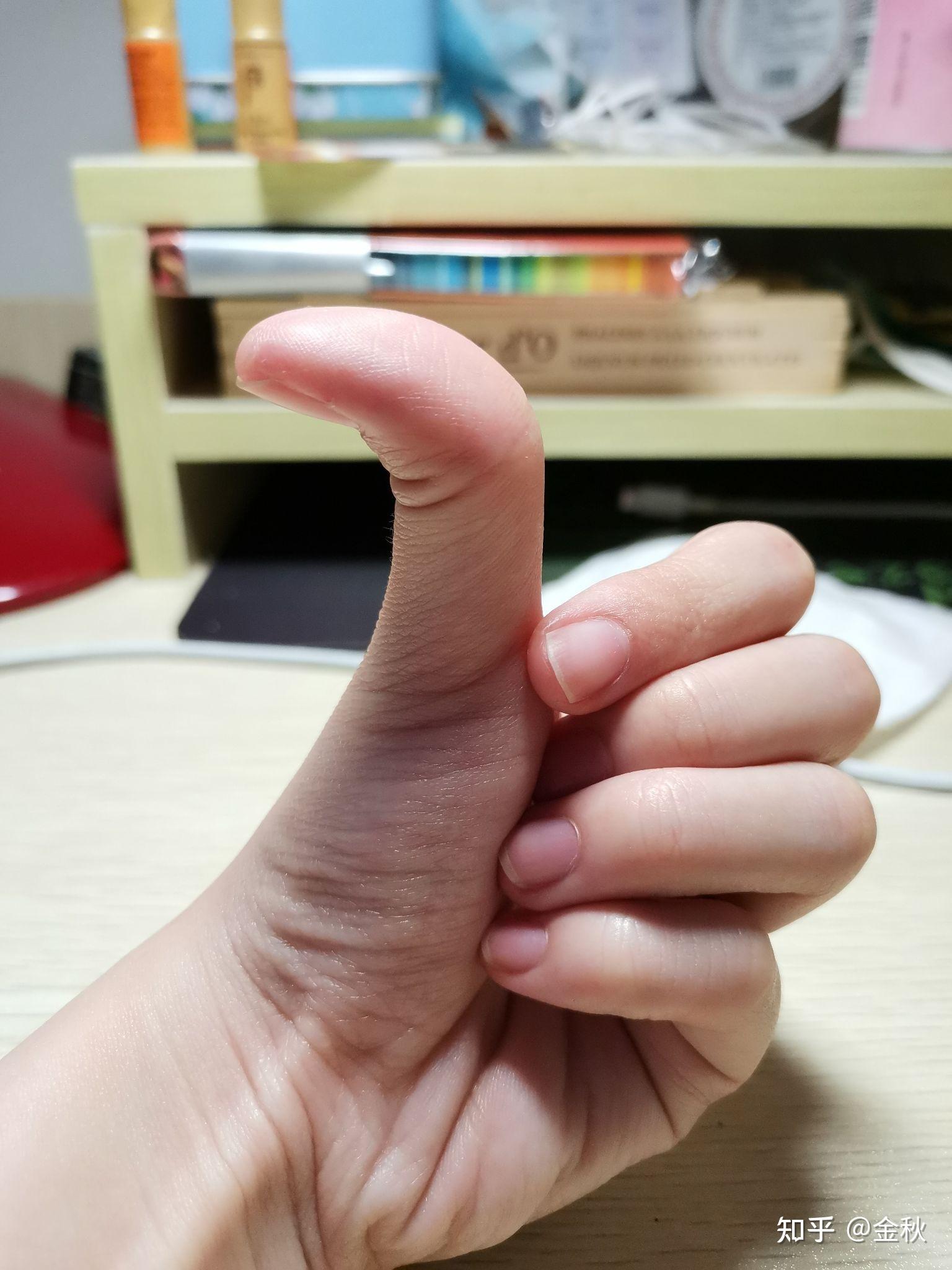 为什么有的人大拇指可以往后弯而有的人不行