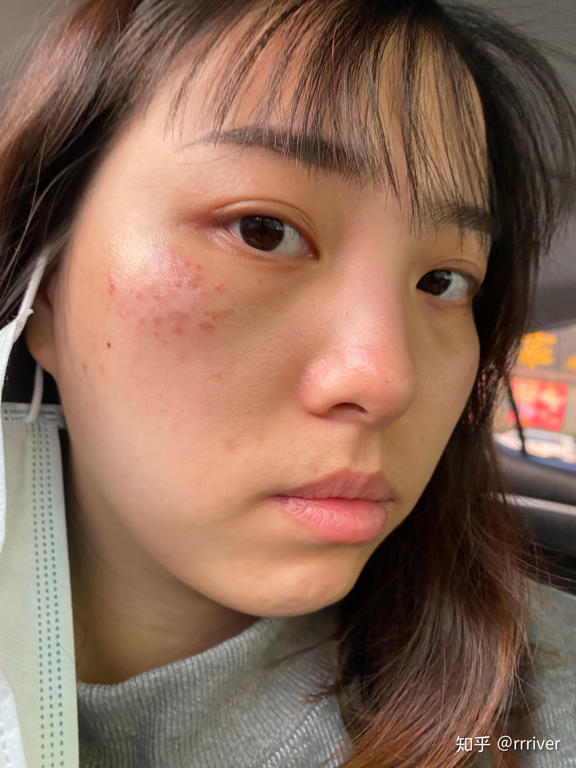 有谁褐青色痣治好过? - 知乎