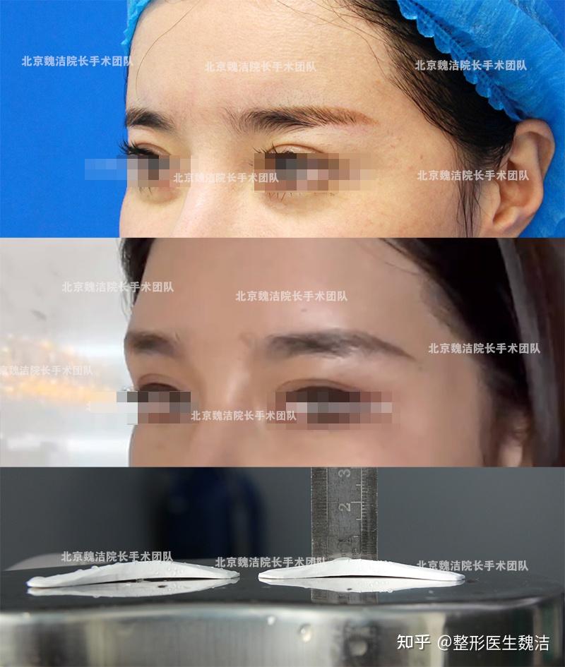 垫了假体眉弓后不好看如何修复?一例眉弓修复手术 - 知乎
