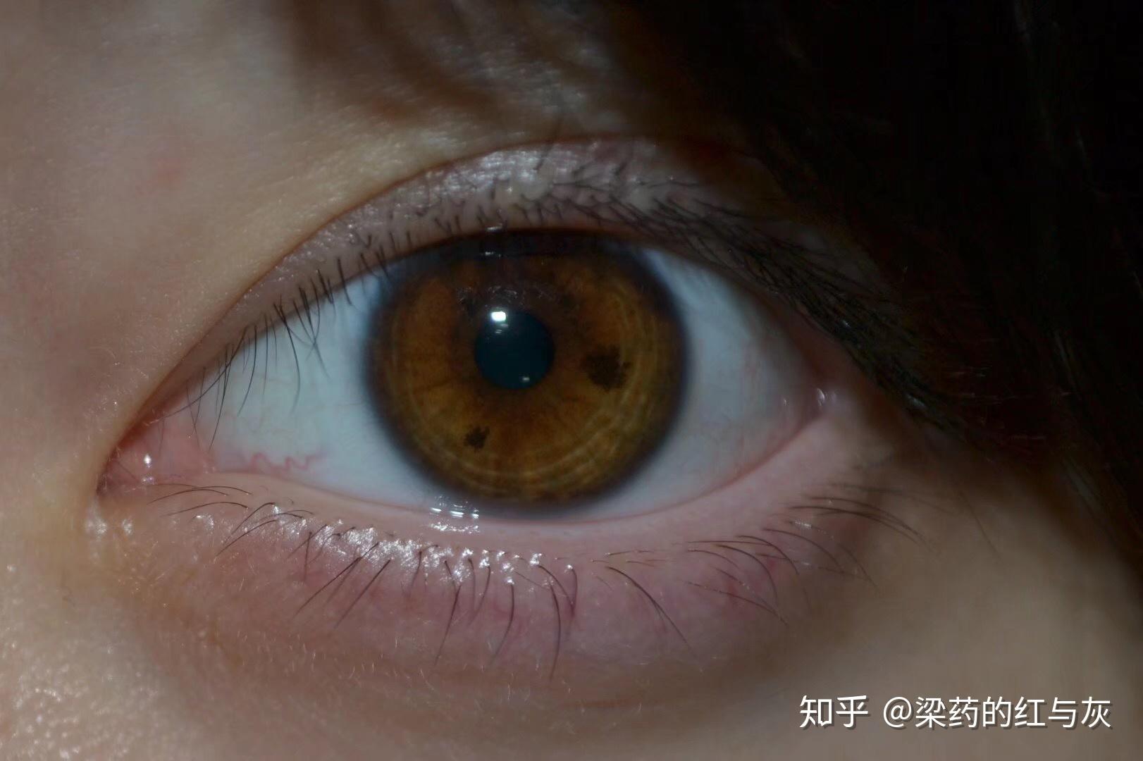 拥有不寻常的虹膜是种怎样的体验?