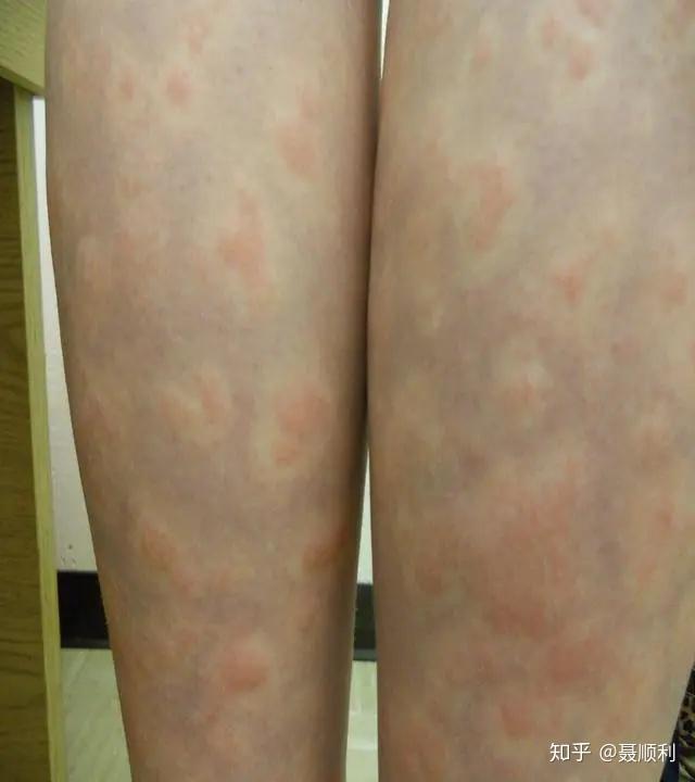 红斑狼疮的不常见皮肤改变(上)