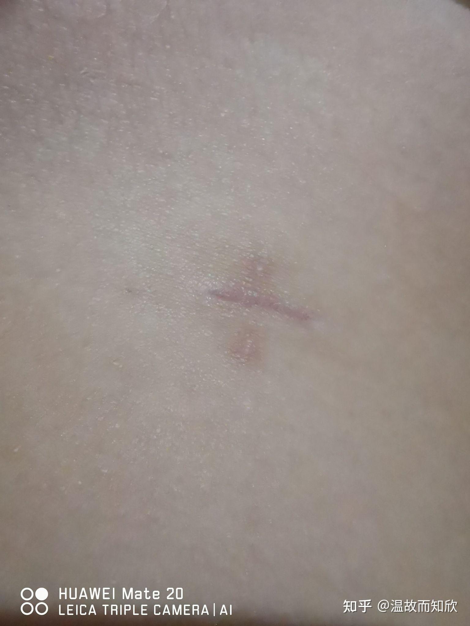 阑尾炎手术疤痕图图片