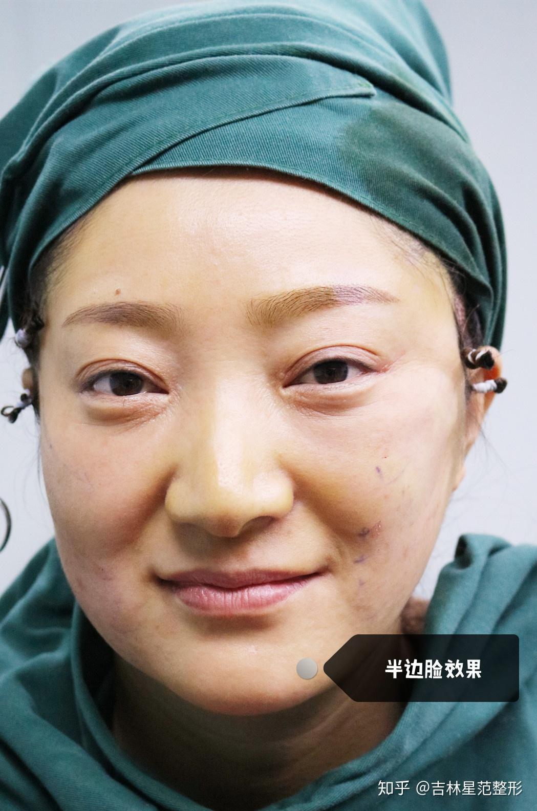 面部衰老的克星微拉美了解一下