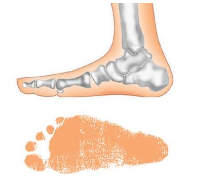 二,扁平足的危害足是人体重要的负重器官和运动器官,参与人体运动和