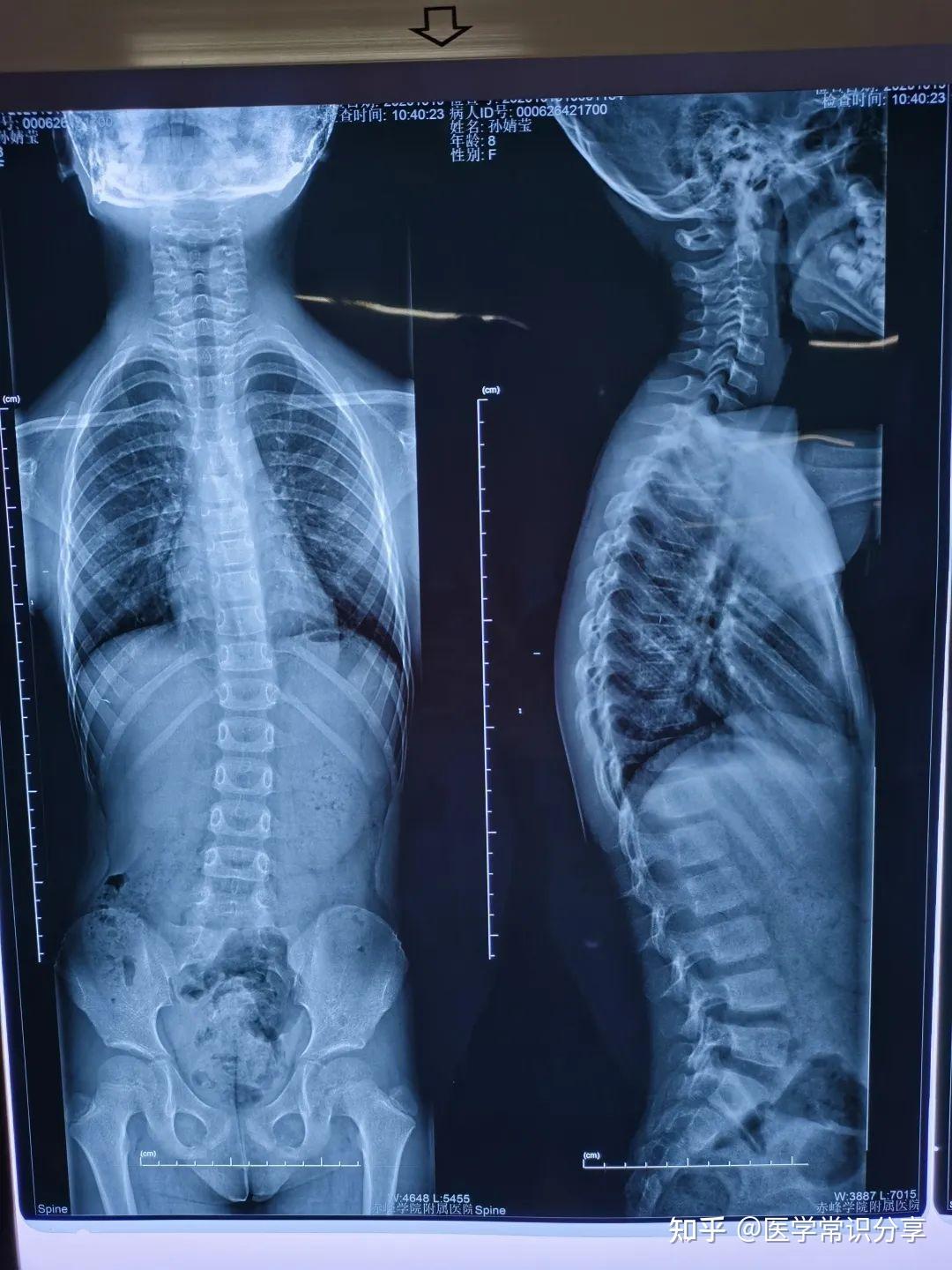 过治疗后▼进过治疗后脊柱侧弯情况明显得到改善,冠状面和矢状面的