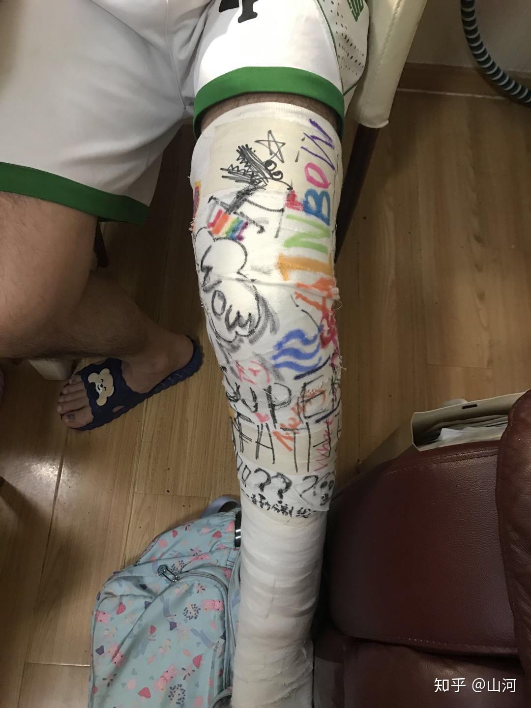 切口恢复蛮好,但能感觉到其近端深部有肿胀,一直长腿石膏固定着,想