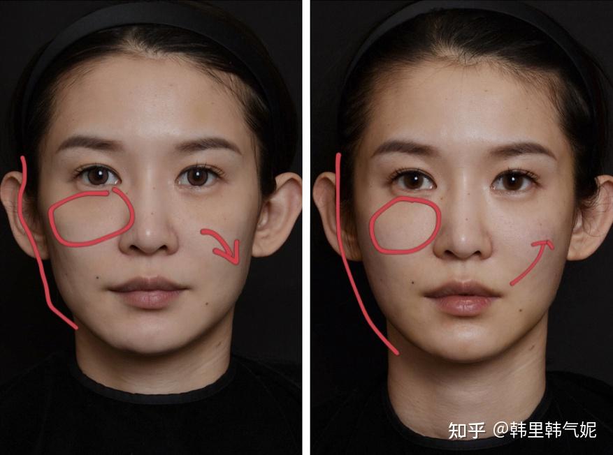 案例为胶原蛋白填充印第安纹泪沟(左术前右术后)以上选了三个问得比较