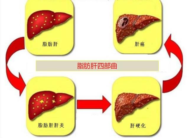 血吸虫性肝硬化图片