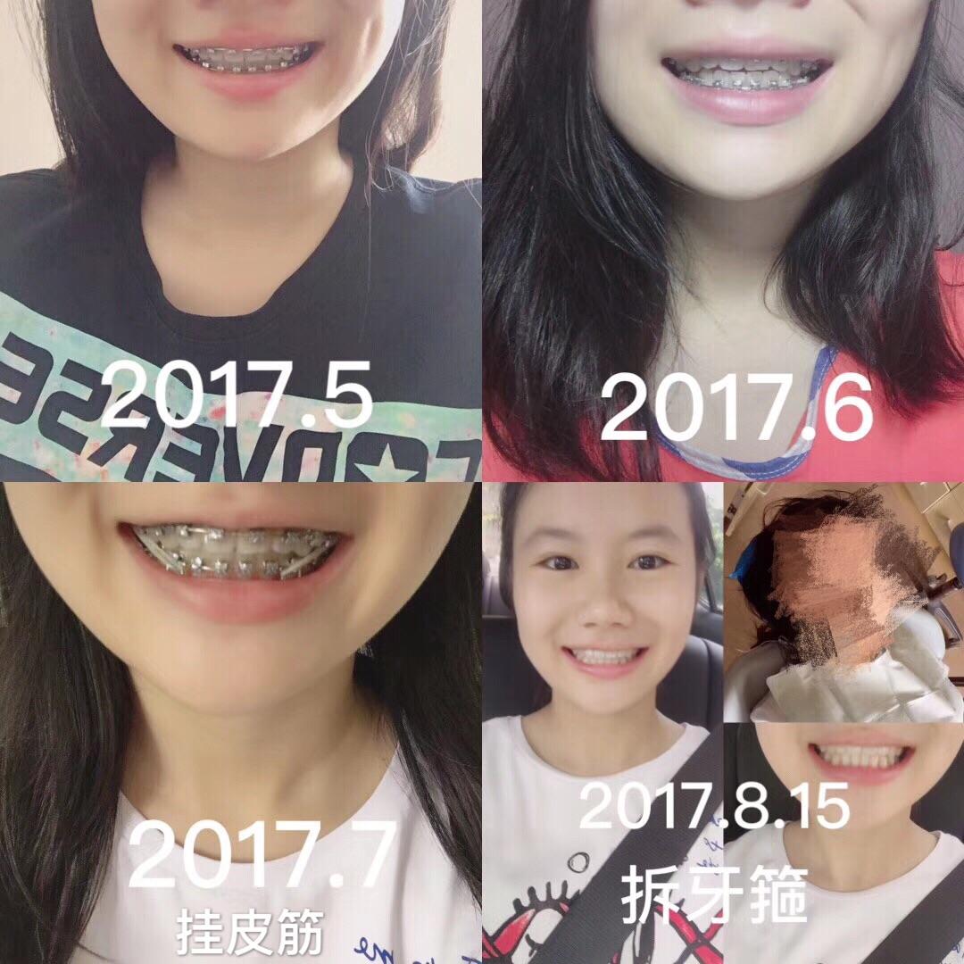 日本CI正畸牙刷进口齿科成人儿童中小头矫正牙套软毛钢牙箍智齿-淘宝网
