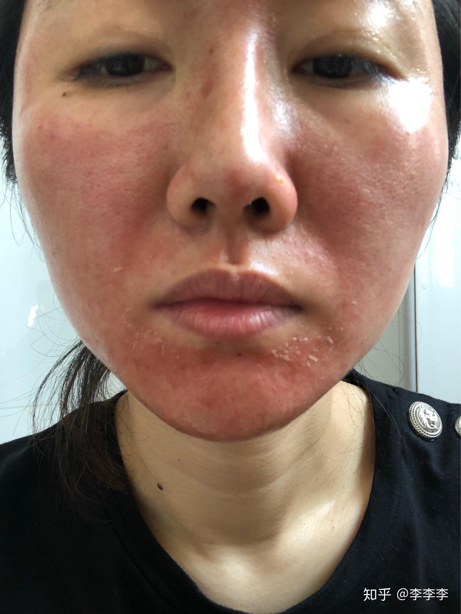 难熬的激素脸生涯终于过去了