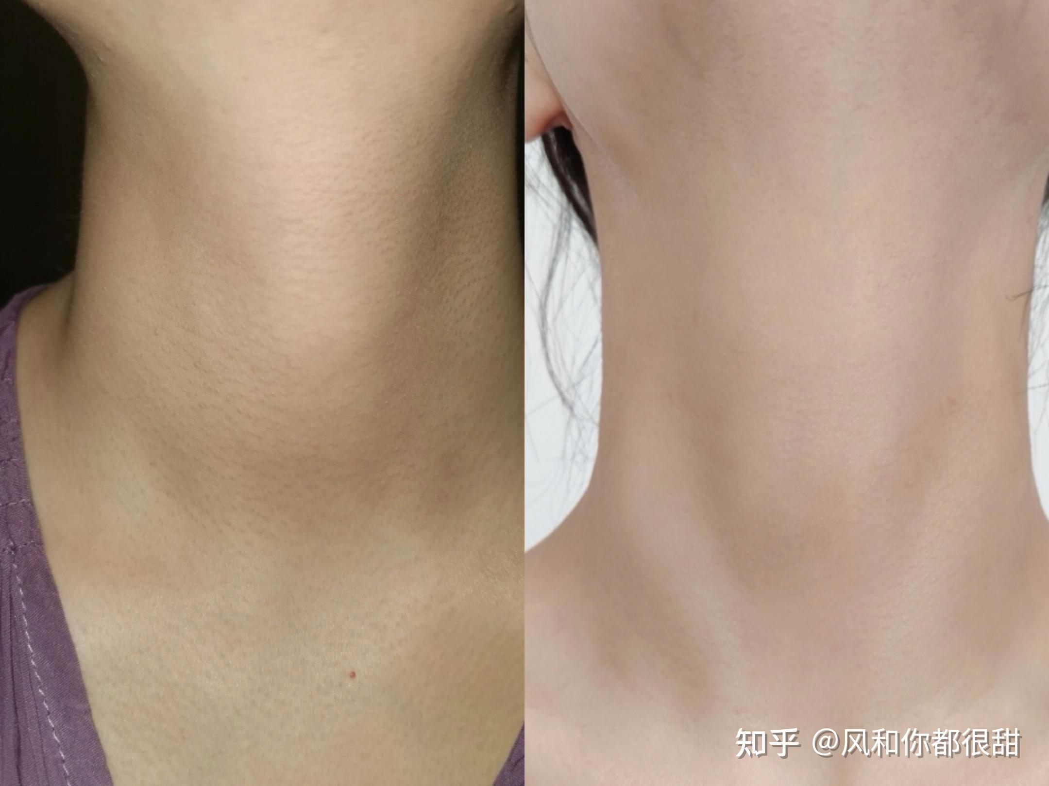 如何减手臂鸡皮肤脖子(怎样改善脖子上的鸡皮肤)