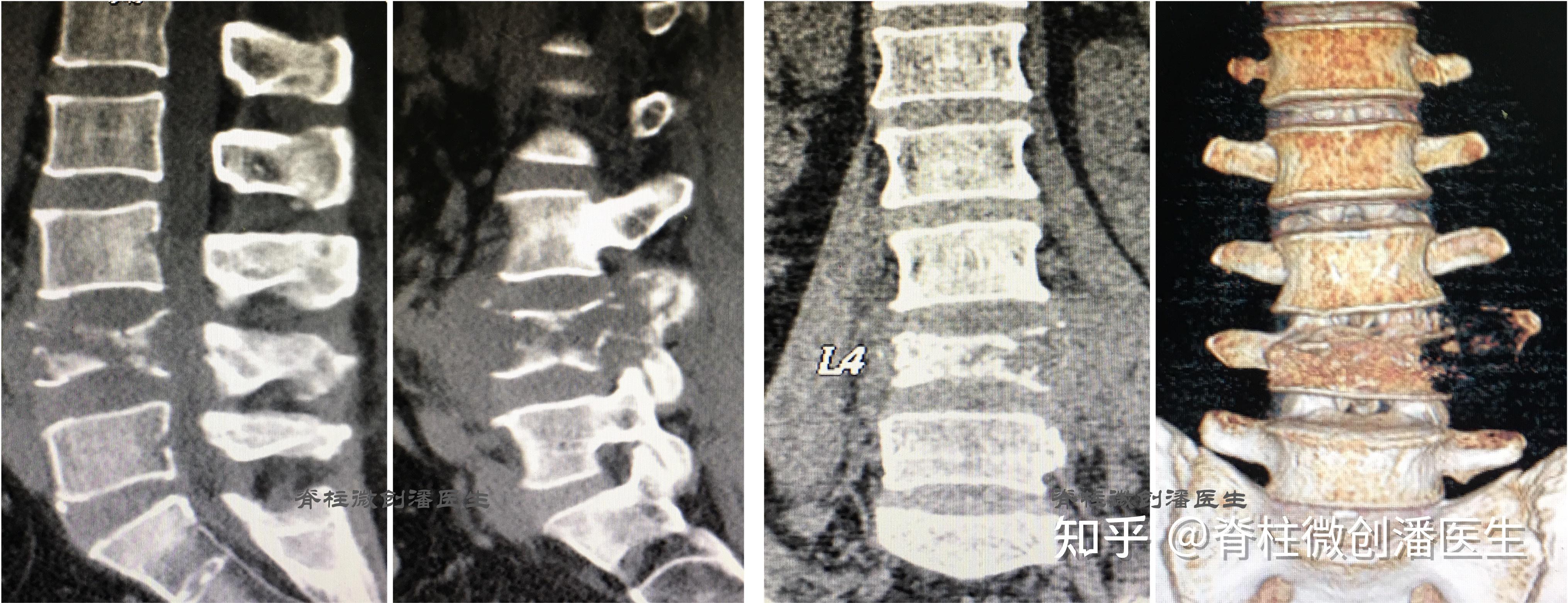 最常见的脊柱肿瘤——脊柱转移瘤