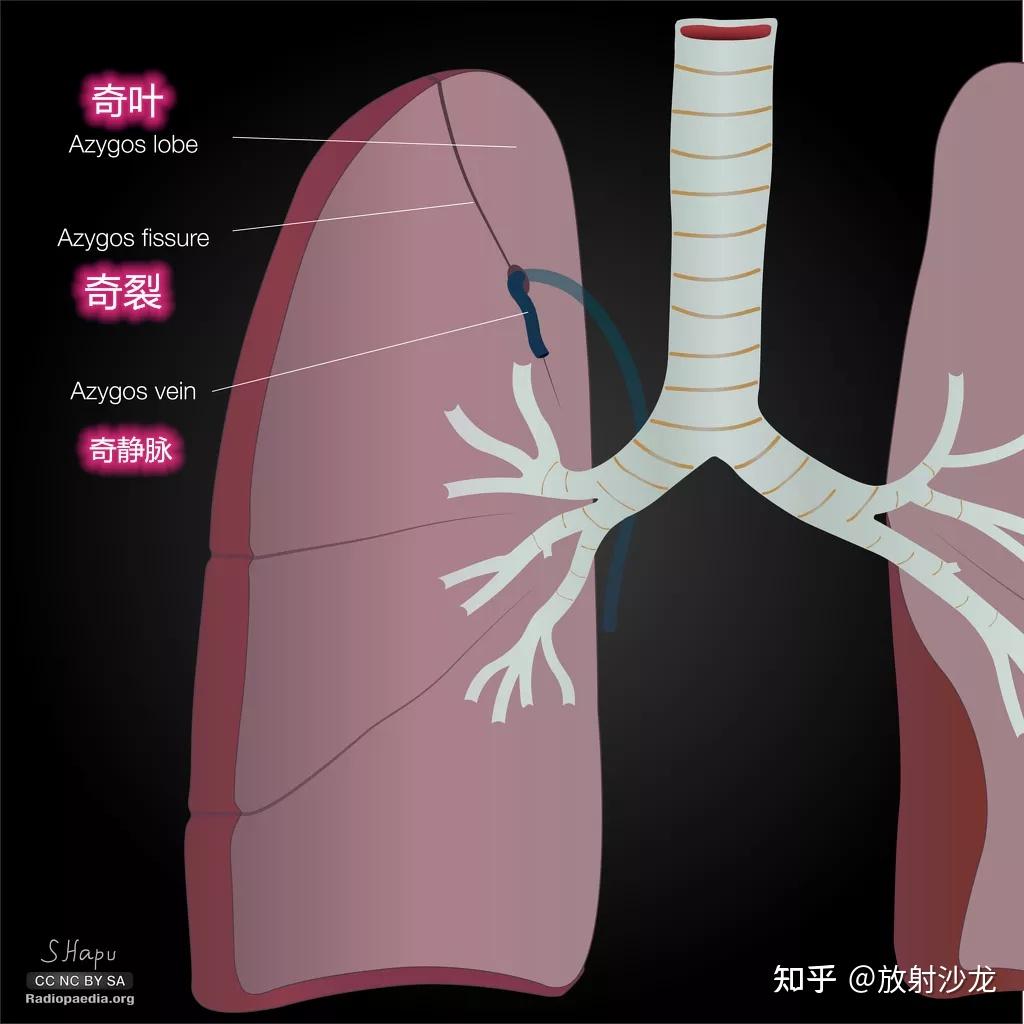多出来的肺裂,你认识几个? - 知乎
