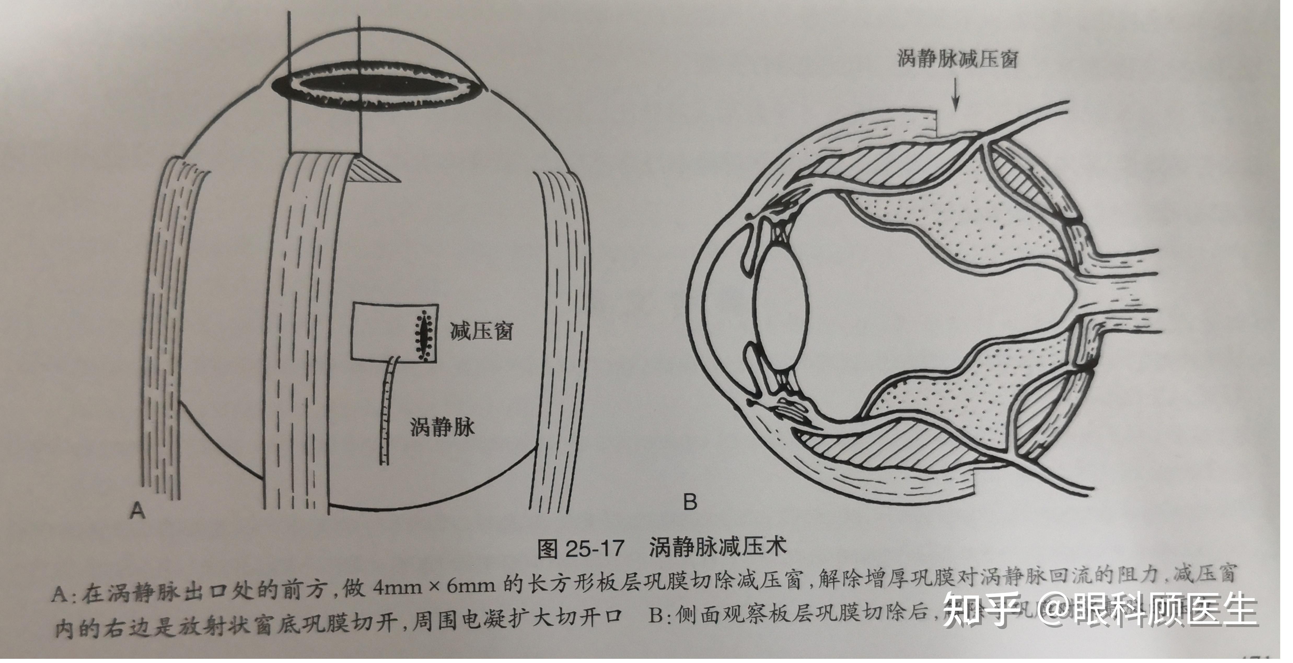 浅谈葡萄膜渗漏综合征 - 知乎