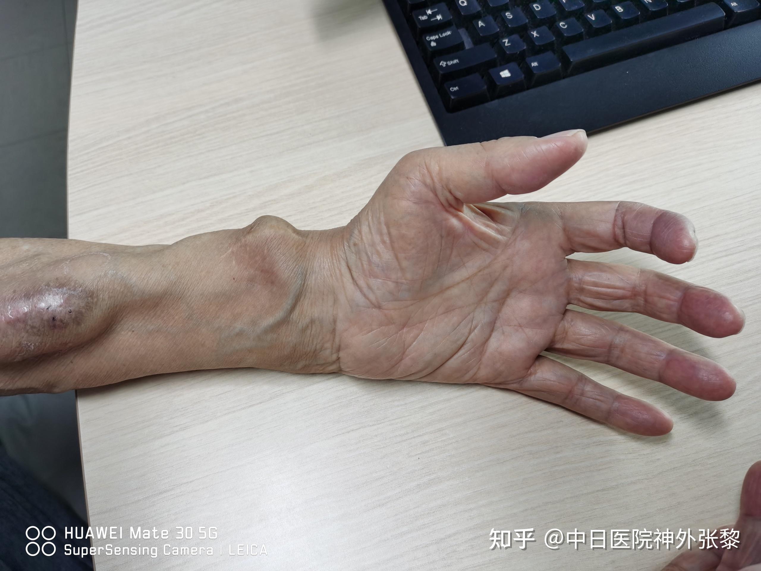 晚期出现手部小肌肉广泛萎缩,手废用,最终形成爪形手3
