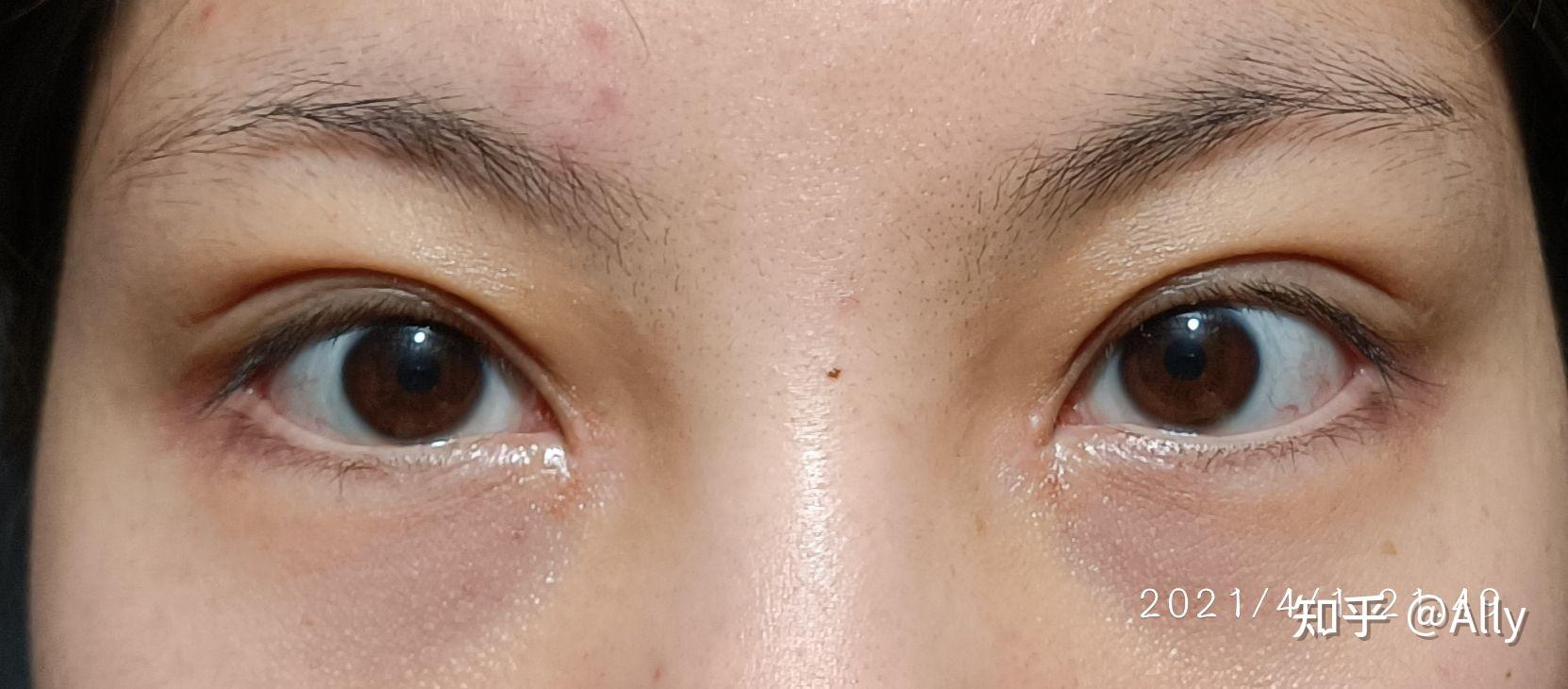 记录在三线小城割双眼皮(恢复过程)