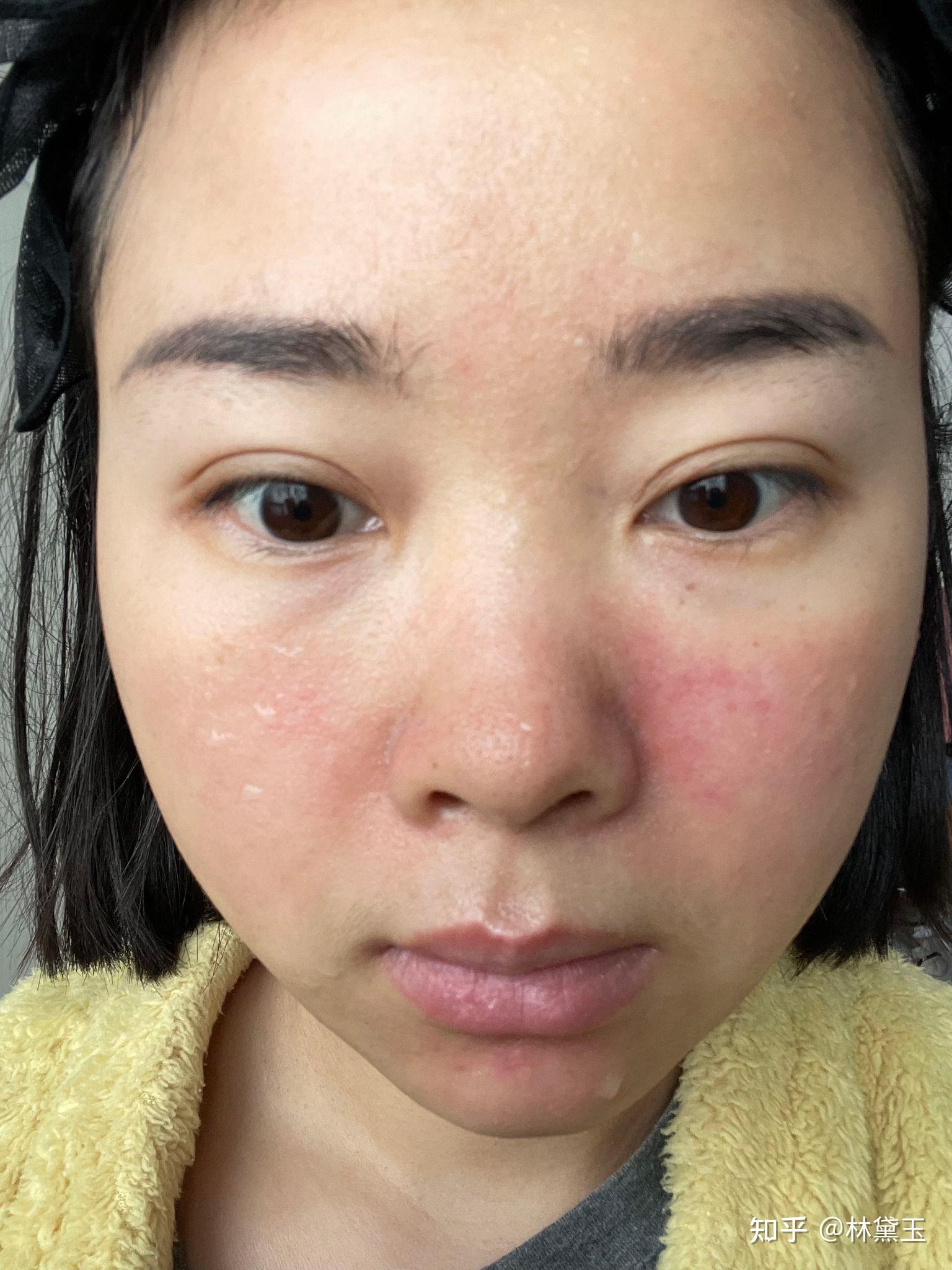 微针第三天啦,上篇文章居然格式弄错了,没有标题