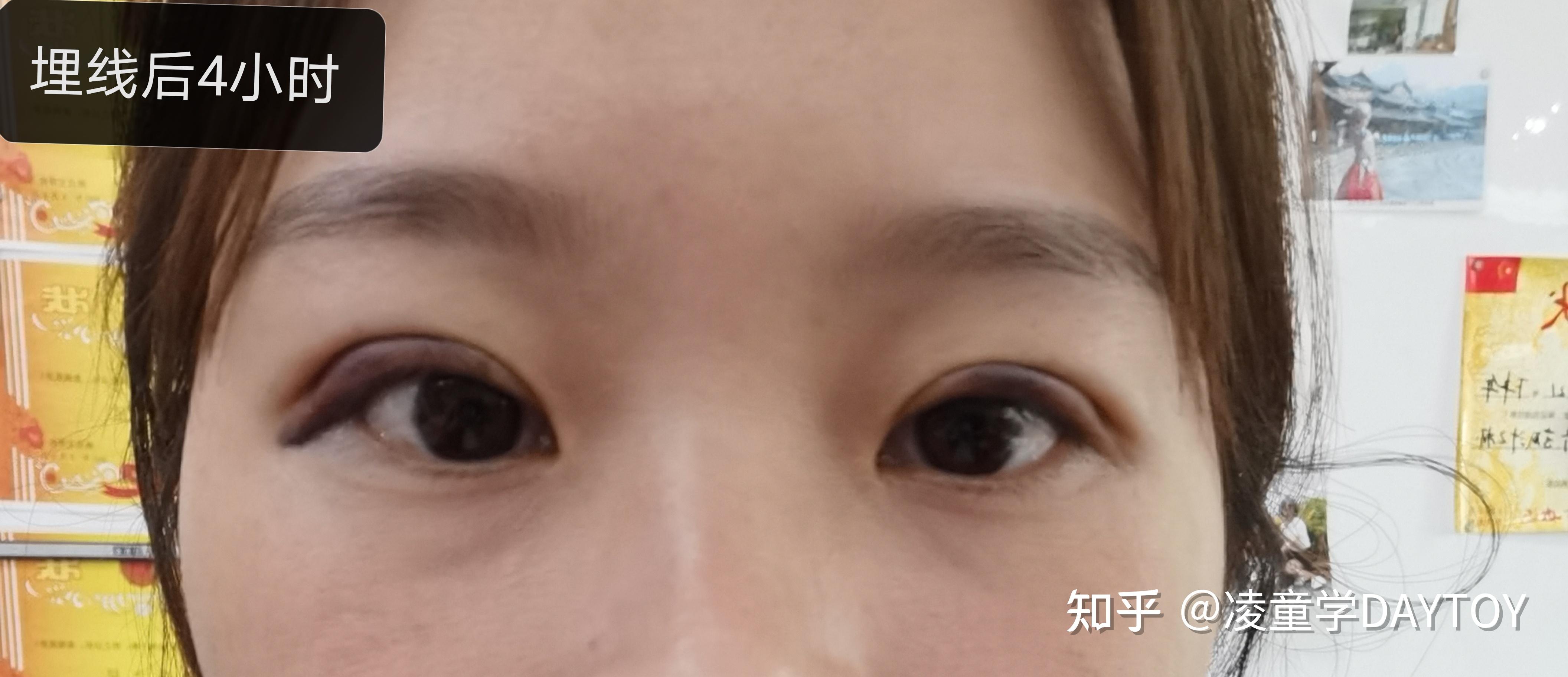 【分享】日本 抽脂埋线双眼皮(超肿单眼皮) - 知乎