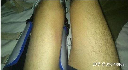 运动性神经元病的起病原因 知乎