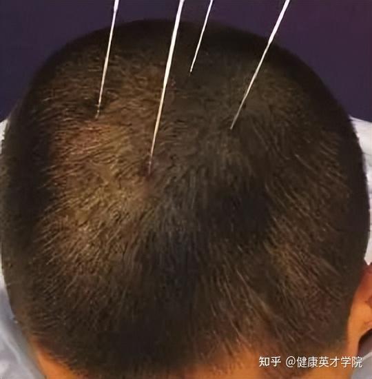带你了解中医针灸“靳三针”疗法:三针秒杀绝技! - 知乎