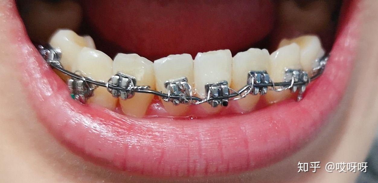 正畸分享虎牙埋伏牙