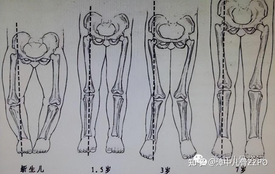 一张图看懂宝宝是不是o型腿