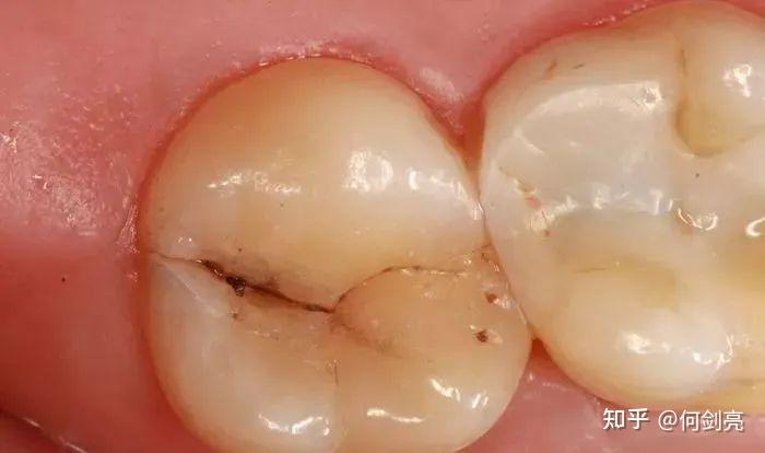 01 牙齿的盔甲软肋