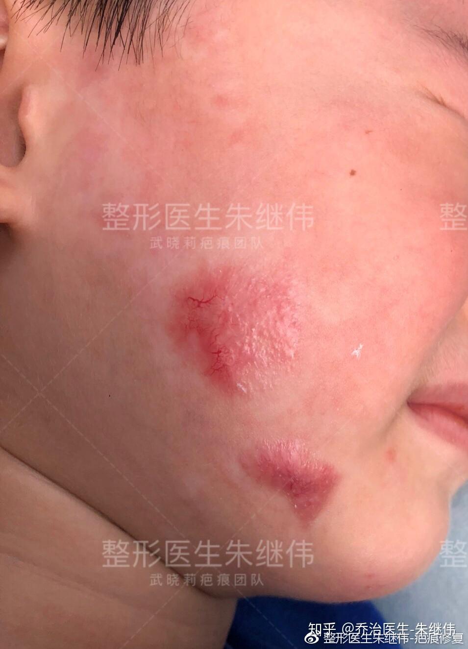 什么样的疤痕是稳定的疤痕整形医生朱继伟