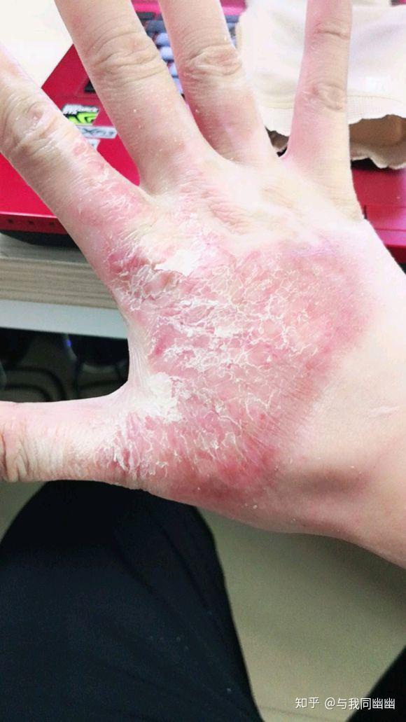 长沙长峰医院烧伤治疗中心(儿童烧烫伤中心)北京疤友烧伤医学研究院